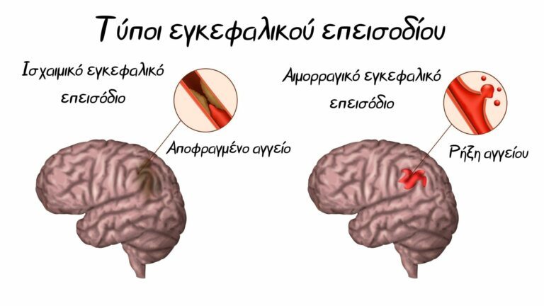 Εγκεφαλικό επεισόδιο και αποκατάσταση