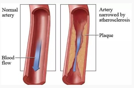 Πως αντιμετωπίζουμε την αθηροσκλήρωση